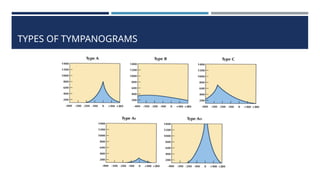 Tympanometry Graph Types Tympanometry for the hearing loss pptx.. | PPTX