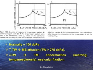 • Normally ~ 100 daPa
∀ ↑ TW  ME effusion (TW > 275 daPa).
∀ ↓ TW           TM    abnormalities      (scarring,
  tympanosclerosis), ossicular fixation.

                       Dr. Mona Selim
 