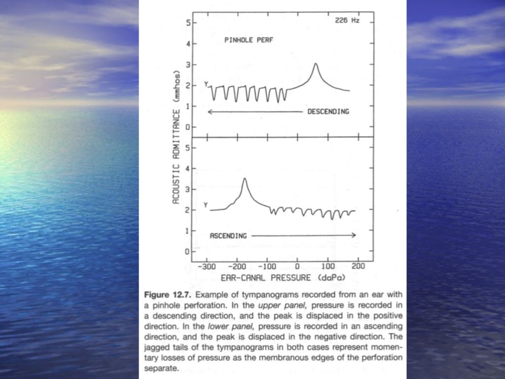 Tympanometry & Clinical Applications