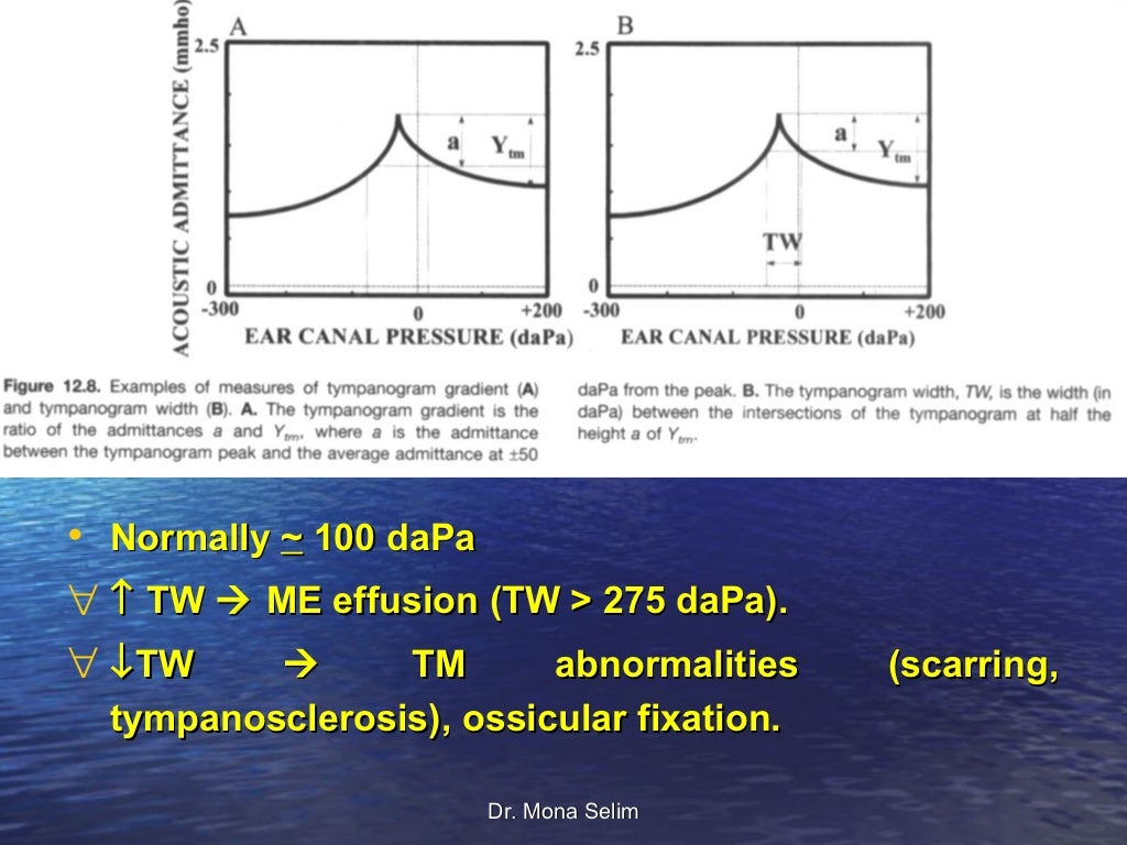 Tympanometry & Clinical Applications