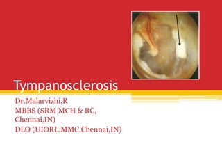 Tympanosclerosis
Dr.Malarvizhi.R
MBBS (SRM MCH & RC,
Chennai,IN)
DLO (UIORL,MMC,Chennai,IN)
 