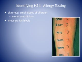 Identifying HS-I: Allergy Testing
• skin test: small doses of allergen
– look for wheal & flare
• measure IgE levels
 