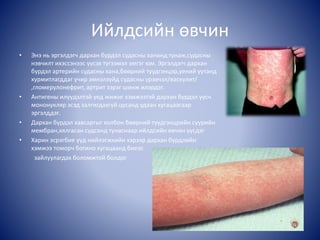 Ийлдсийн өвчин
• Энэ нь эргэлдэгч дархан бүрдэл судасны хананд тунаж,судасны
нэвчилт ихэссэнээс үүсэх түгээмэл эмгэг юм. Эргэлдэгч дархан
бүрдэл артерийн судасны хана,бөөрний туудгэнцэр,үений уутанд
хурмитлагддаг учир эмнэлзүйд судасны үрэвчэл/васкулит/
,гломерулонефрит, артрит зэрэг шинж илэрдэг.
• Антигены илүүдэлтэй үед жижиг хэмжээтэй дархан бүрдэл үүсч
мононукляр эсэд залгигдахгүй цусанд удаан хугацаагаар
эргэлддэг.
• Дархан бүрдэл хавсаргыг холбон бөөрний түүдгэнцрийн суурийн
мембран,хялгасан судсанд тунаснаар ийлдсийн өвчин үүсдэг
• Харин эсрэгбие үүд нийлэгжхийн хэрээр дархан бүрдлийн
хэмжээ томорч богино хугацаанд биеэс
зайлуулагдах боломжтой болдог
 