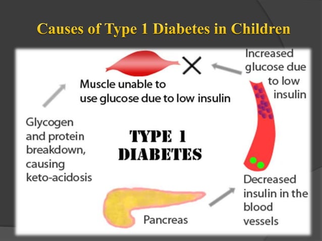Type 1 diabetes in children | PPTX