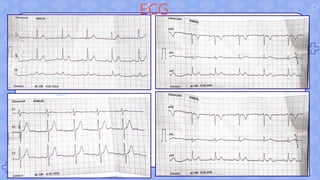 ECG
 