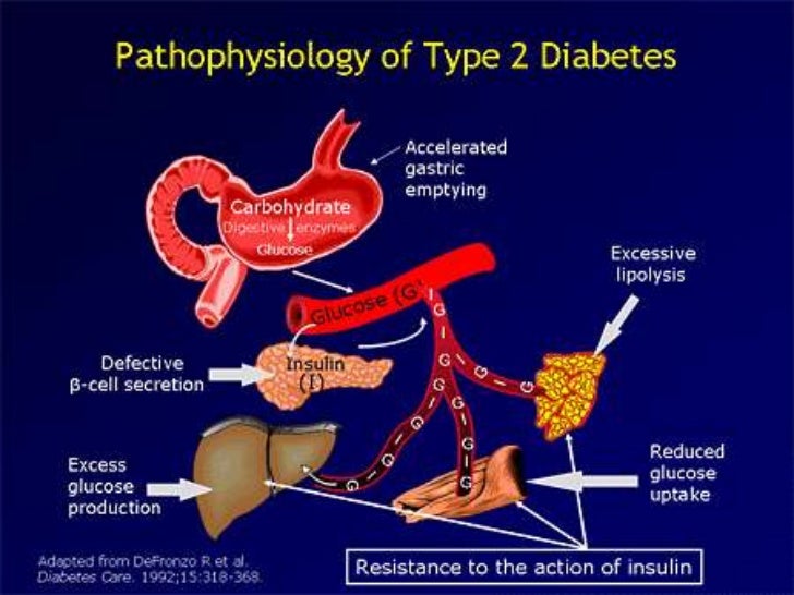 Diabetes Mellitus And Type 2 Diabetes