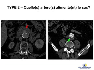 TYPE 2 – Quelle(s) artère(s) alimente(nt) le sac?
 