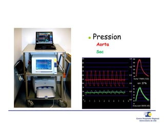  Pression
Aorta
Sac
 