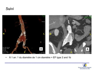 Suivi
• À 1 an:  du diamètre de 1 cm diamètre + EF type 2 and 1b
 