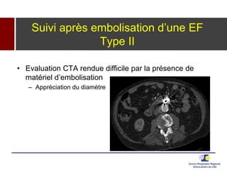 Suivi après embolisation d’une EF
Type II
• Evaluation CTA rendue difficile par la présence de
matériel d’embolisation
– Appréciation du diamètre
 