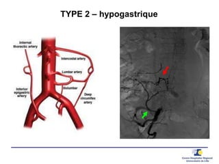TYPE 2 – hypogastrique
 