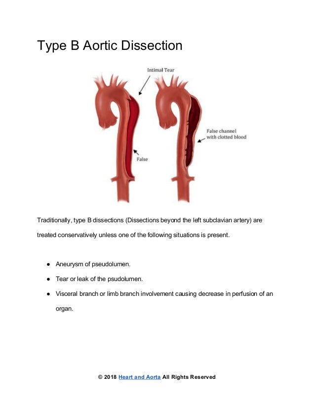 ﻿Type B Aortic Dissection