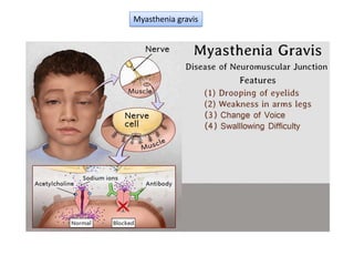 Myasthenia gravis
 