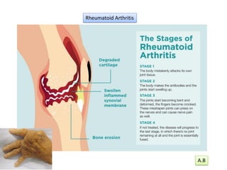 Rheumatoid Arthritis
A.B
 