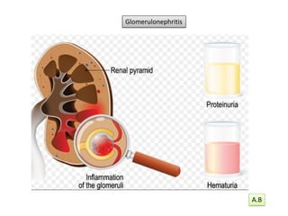 Glomerulonephritis
A.B
 