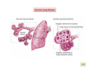 Farmers lung disease
A.B
 