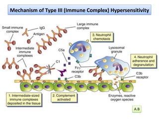 Mechanism of Type III (Immune Complex) Hypersensitivity
A.B
 