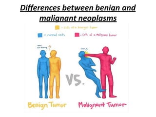 Differences between benign and
malignant neoplasms
 