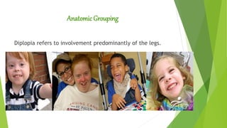 AnatomicGrouping
Diplopia refers to involvement predominantly of the legs.
 