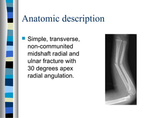Anatomic description
 Simple, transverse,
non-communited
midshaft radial and
ulnar fracture with
30 degrees apex
radial angulation.
 