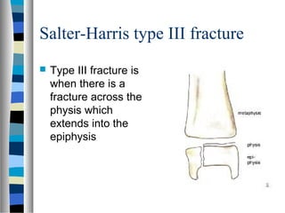 Salter-Harris type III fracture
 Type III fracture is
when there is a
fracture across the
physis which
extends into the
epiphysis
 