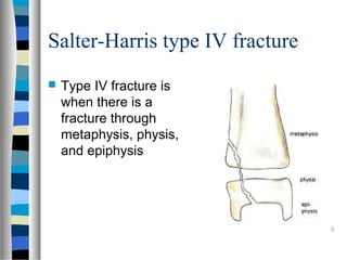 Salter-Harris type IV fracture
 Type IV fracture is
when there is a
fracture through
metaphysis, physis,
and epiphysis
 