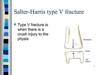 Salter-Harris type V fracture
 Type V fracture is
when there is a
crush injury to the
physis
 