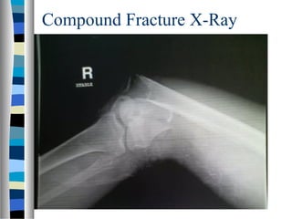 Compound Fracture X-Ray
 