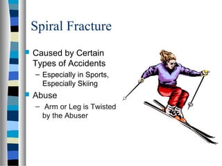Spiral Fracture
 Caused by Certain
Types of Accidents
– Especially in Sports,
Especially Skiing
 Abuse
– Arm or Leg is Twisted
by the Abuser
 