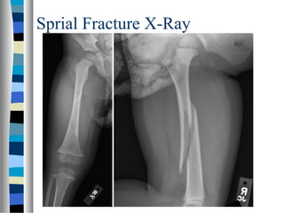 Sprial Fracture X-Ray
 
