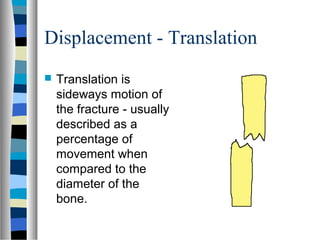 Displacement - Translation
 Translation is
sideways motion of
the fracture - usually
described as a
percentage of
movement when
compared to the
diameter of the
bone.
 