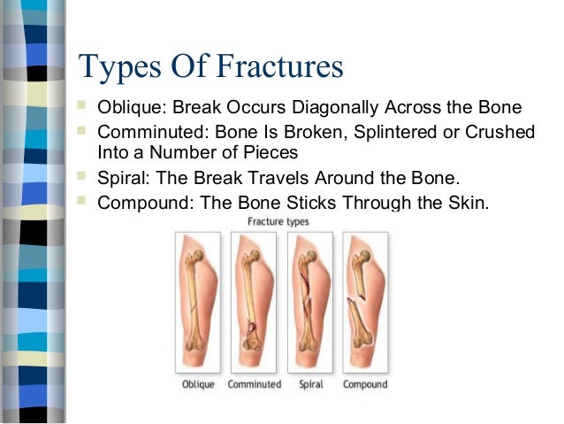 Types and classification of fractures