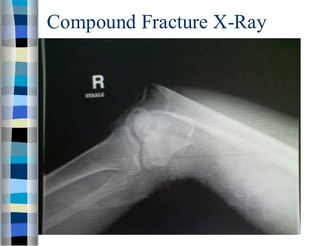 Types And Classification Of Fractures