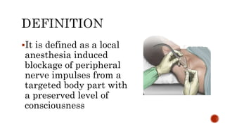 It is defined as a local
anesthesia induced
blockage of peripheral
nerve impulses from a
targeted body part with
a preserved level of
consciousness
 