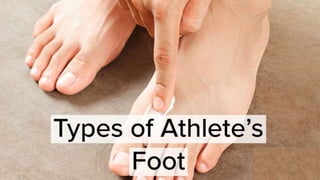 Types of athlete's foot