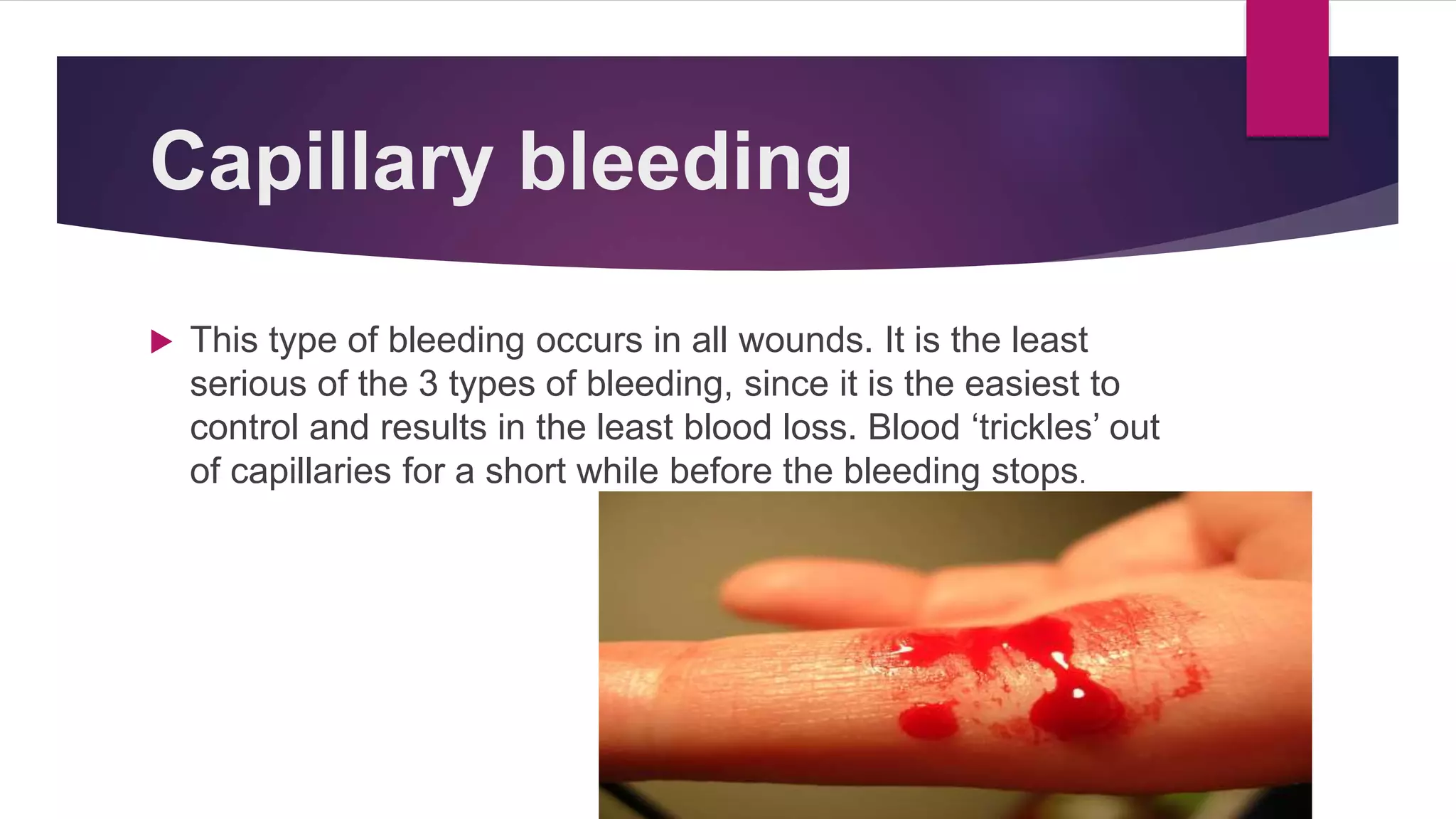 Capillary bleeding
 This type of bleeding occurs in all wounds. It is the least
serious of the 3 types of bleeding, since it is the easiest to
control and results in the least blood loss. Blood ‘trickles’ out
of capillaries for a short while before the bleeding stops.
 
