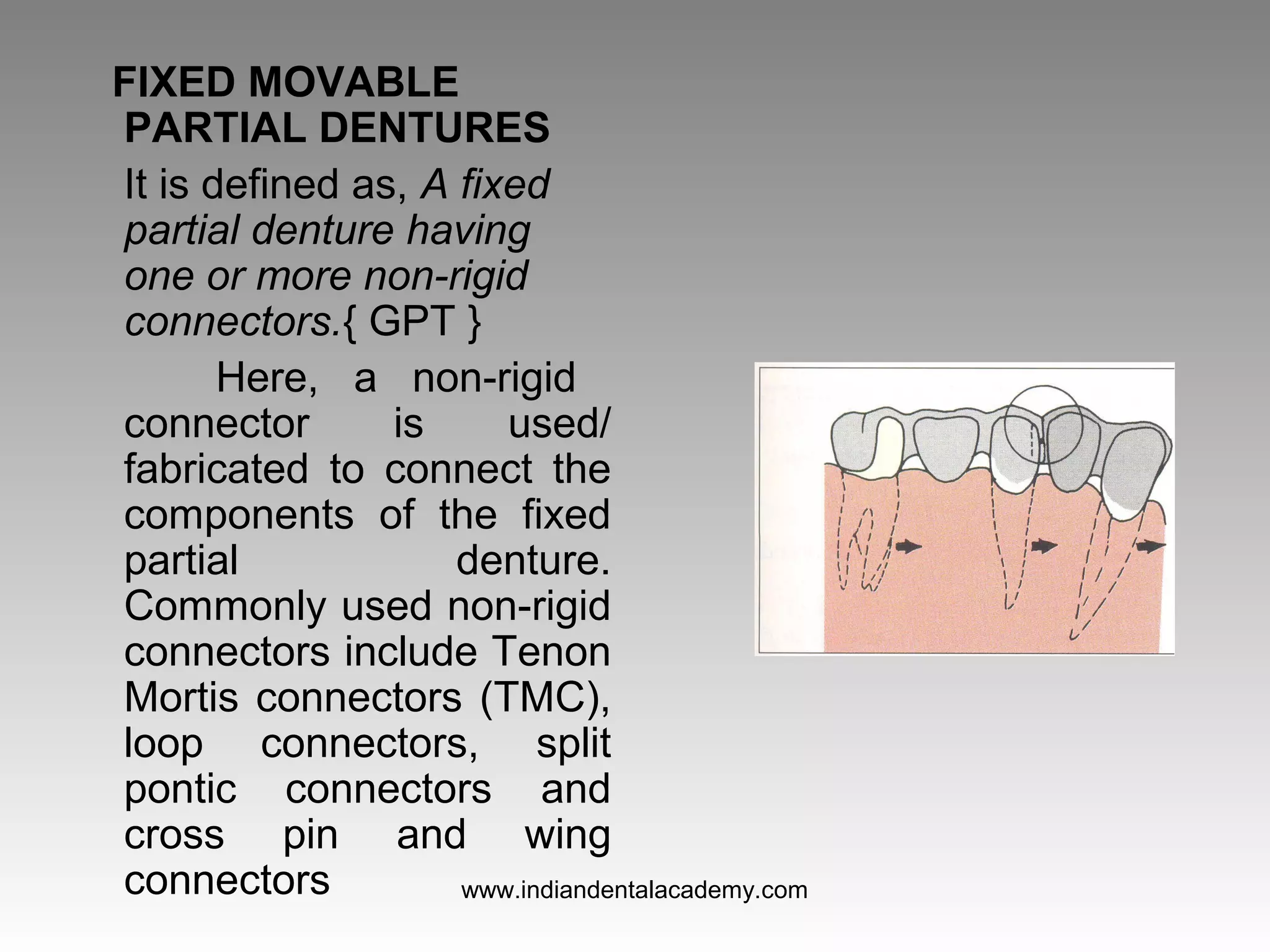 FIXED MOVABLE
PARTIAL DENTURES
It is defined as, A fixed
partial denture having
one or more non-rigid
connectors.{ GPT }
Here, a non-rigid
connector is used/
fabricated to connect the
components of the fixed
partial denture.
Commonly used non-rigid
connectors include Tenon
Mortis connectors (TMC),
loop connectors, split
pontic connectors and
cross pin and wing
connectors www.indiandentalacademy.com
 