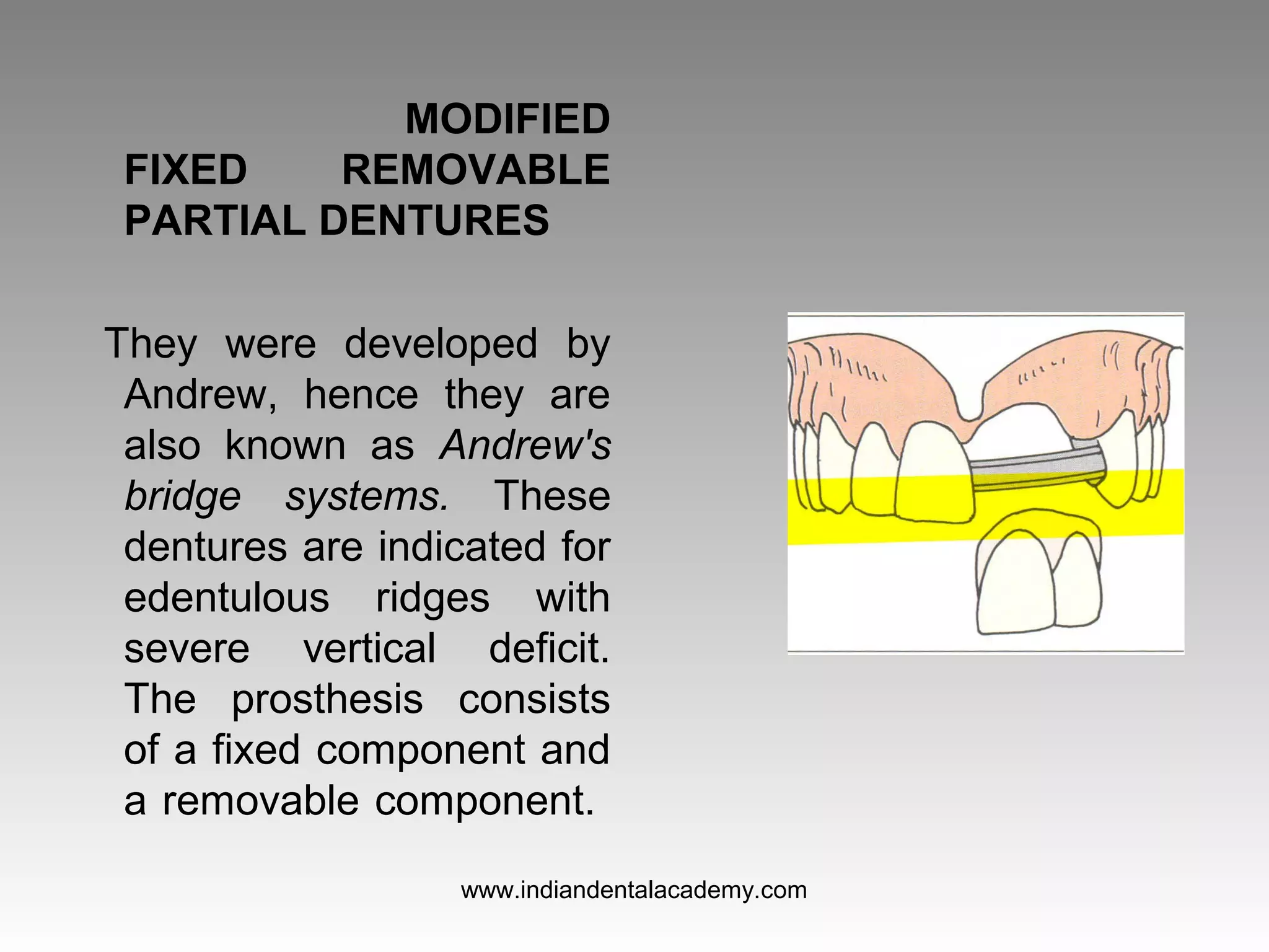 MODIFIED
FIXED REMOVABLE
PARTIAL DENTURES
They were developed by
Andrew, hence they are
also known as Andrew's
bridge systems. These
dentures are indicated for
edentulous ridges with
severe vertical deficit.
The prosthesis consists
of a fixed component and
a removable component.
www.indiandentalacademy.com
 