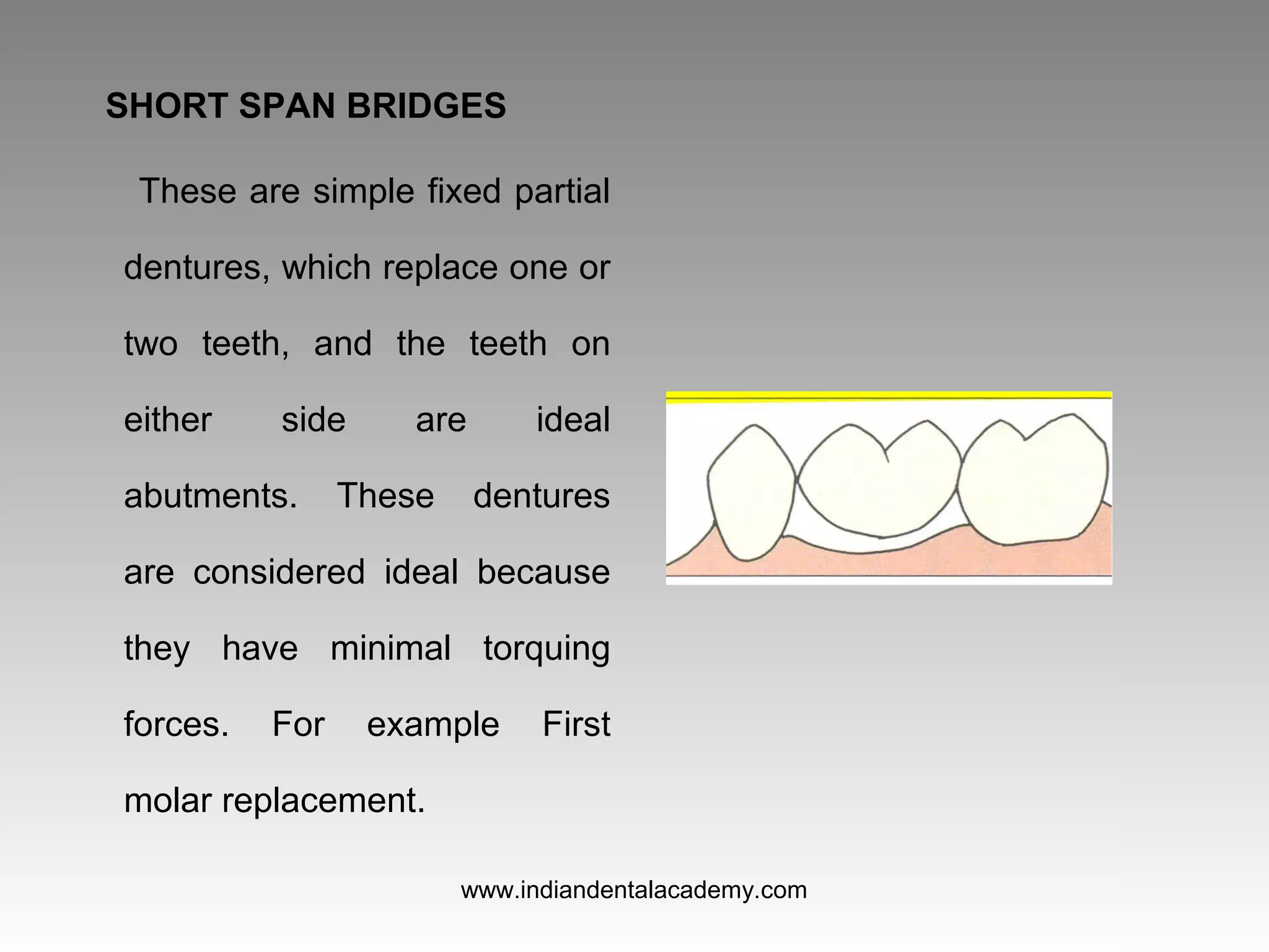SHORT SPAN BRIDGES
These are simple fixed partial
dentures, which replace one or
two teeth, and the teeth on
either side are ideal
abutments. These dentures
are considered ideal because
they have minimal torquing
forces. For example First
molar replacement.
www.indiandentalacademy.com
 