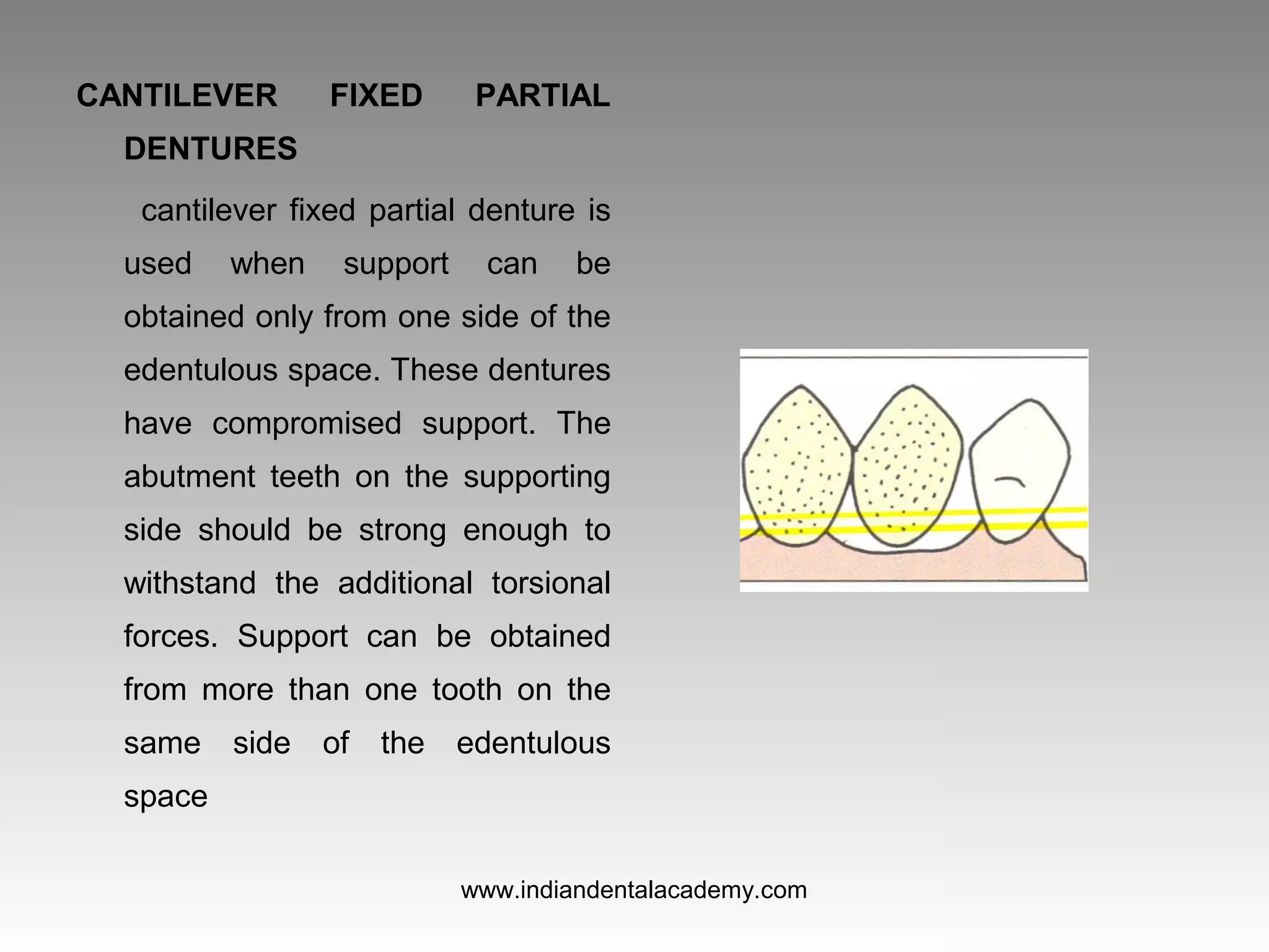 CANTILEVER FIXED PARTIAL
DENTURES
cantilever fixed partial denture is
used when support can be
obtained only from one side of the
edentulous space. These dentures
have compromised support. The
abutment teeth on the supporting
side should be strong enough to
withstand the additional torsional
forces. Support can be obtained
from more than one tooth on the
same side of the edentulous
space
www.indiandentalacademy.com
 