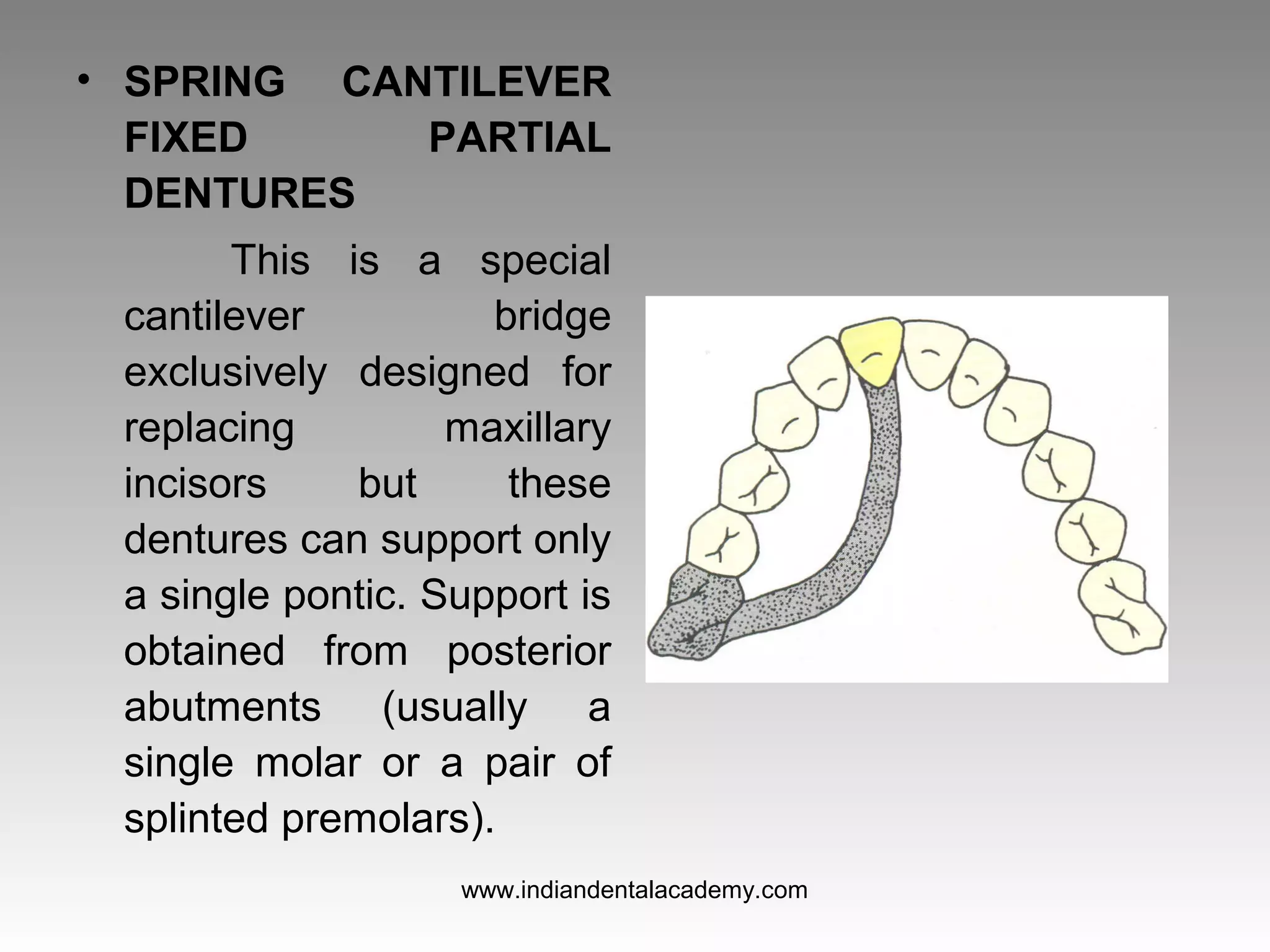 • SPRING CANTILEVER
FIXED PARTIAL
DENTURES
This is a special
cantilever bridge
exclusively designed for
replacing maxillary
incisors but these
dentures can support only
a single pontic. Support is
obtained from posterior
abutments (usually a
single molar or a pair of
splinted premolars).
www.indiandentalacademy.com
 