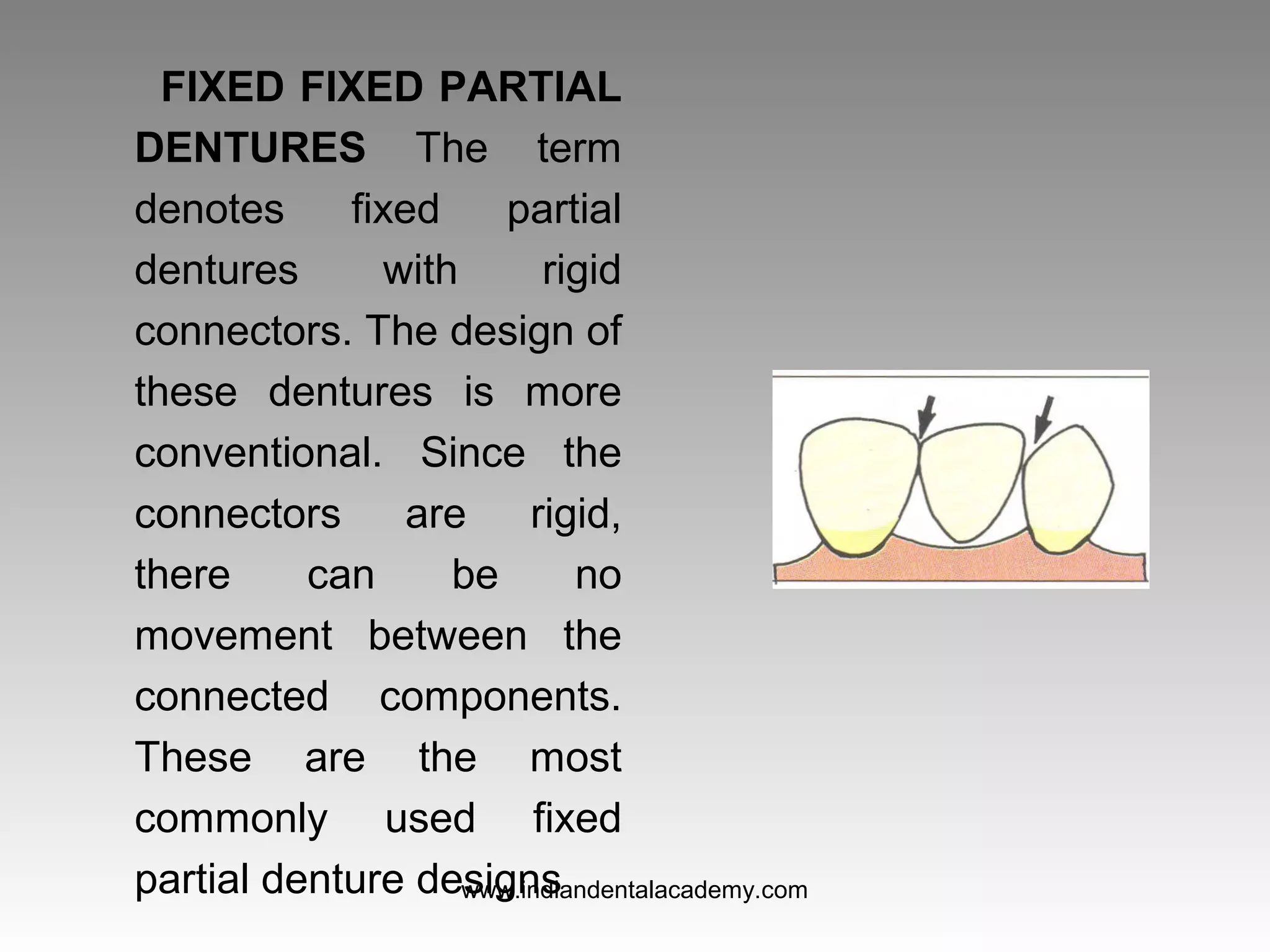 FIXED FIXED PARTIAL
DENTURES The term
denotes fixed partial
dentures with rigid
connectors. The design of
these dentures is more
conventional. Since the
connectors are rigid,
there can be no
movement between the
connected components.
These are the most
commonly used fixed
partial denture designswww.indiandentalacademy.com
 