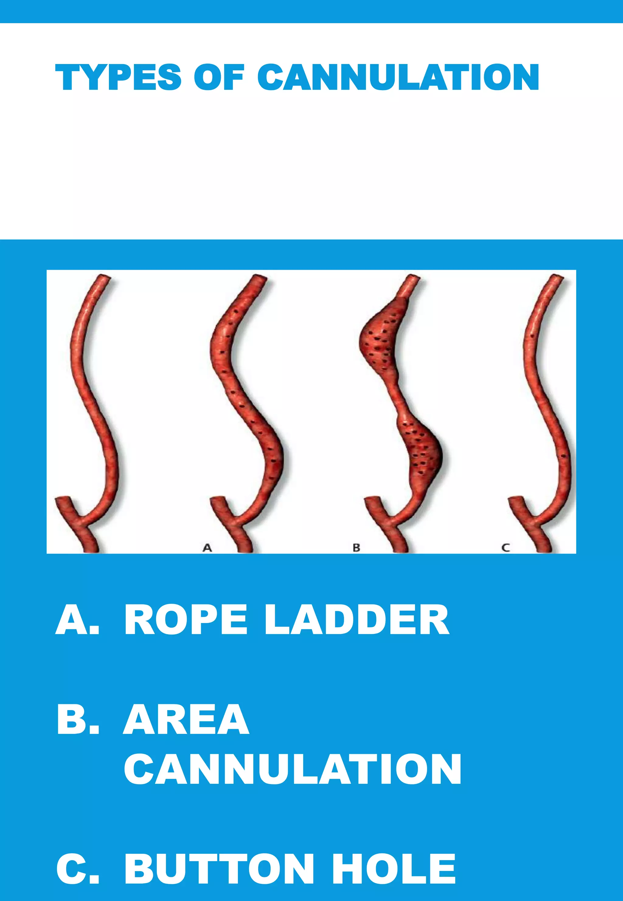 TYPES OF CANNULATION
A. ROPE LADDER
B. AREA
CANNULATION
C. BUTTON HOLE