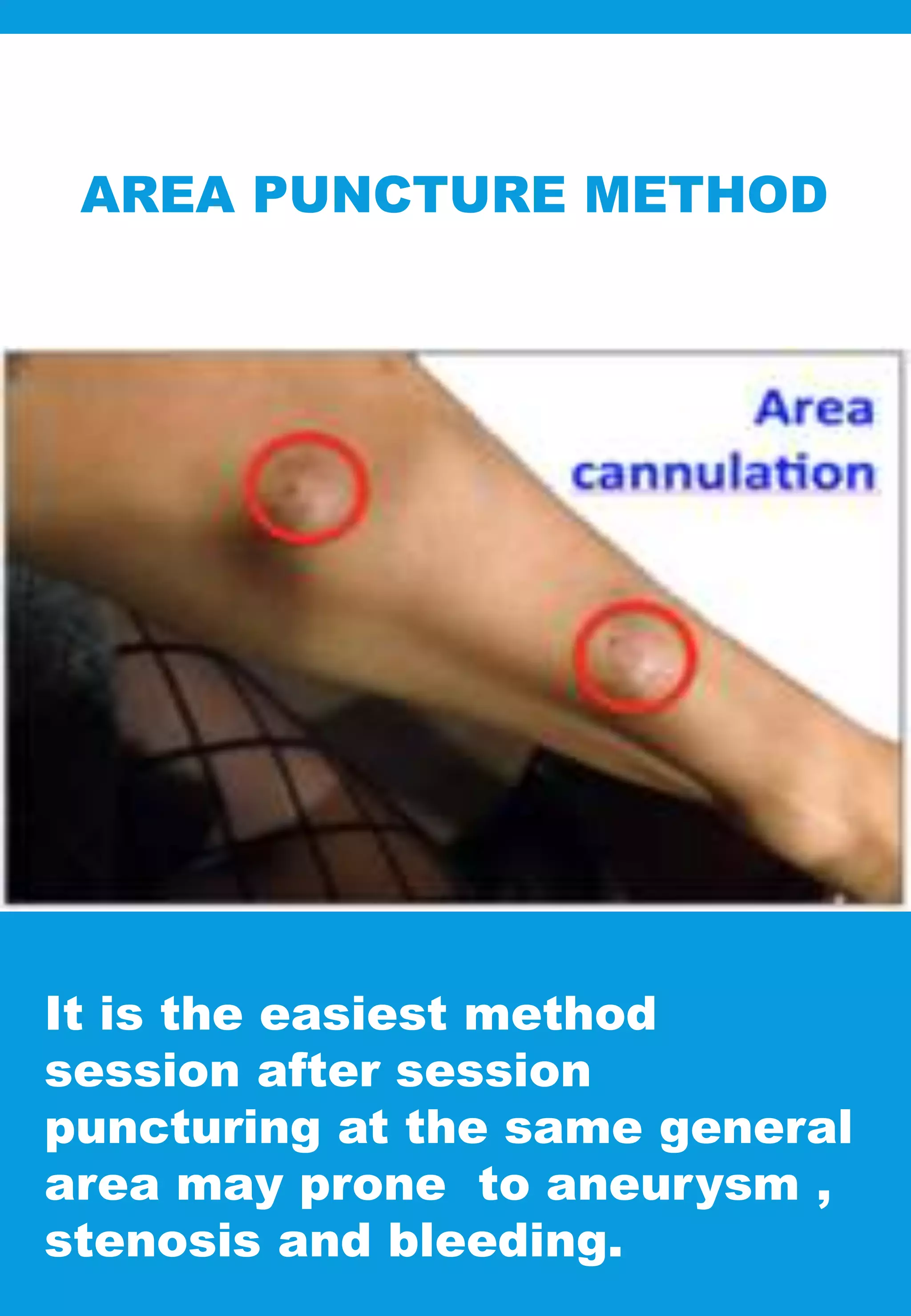 AREA PUNCTURE METHOD
It is the easiest method
session after session
puncturing at the same general
area may prone to aneurysm ,
stenosis and bleeding.