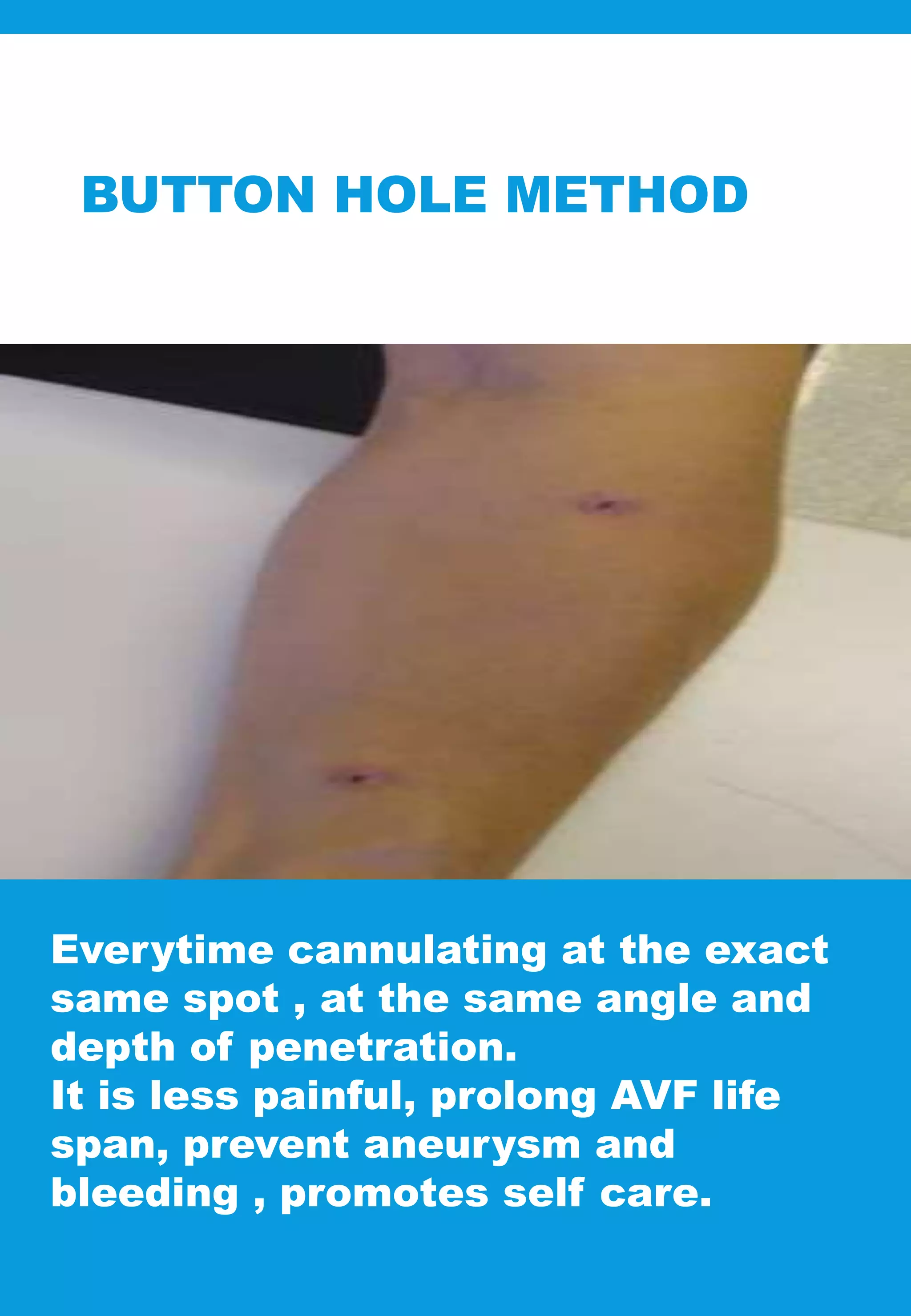 BUTTON HOLE METHOD
Everytime cannulating at the exact
same spot , at the same angle and
depth of penetration.
It is less painful, prolong AVF life
span, prevent aneurysm and
bleeding , promotes self care.