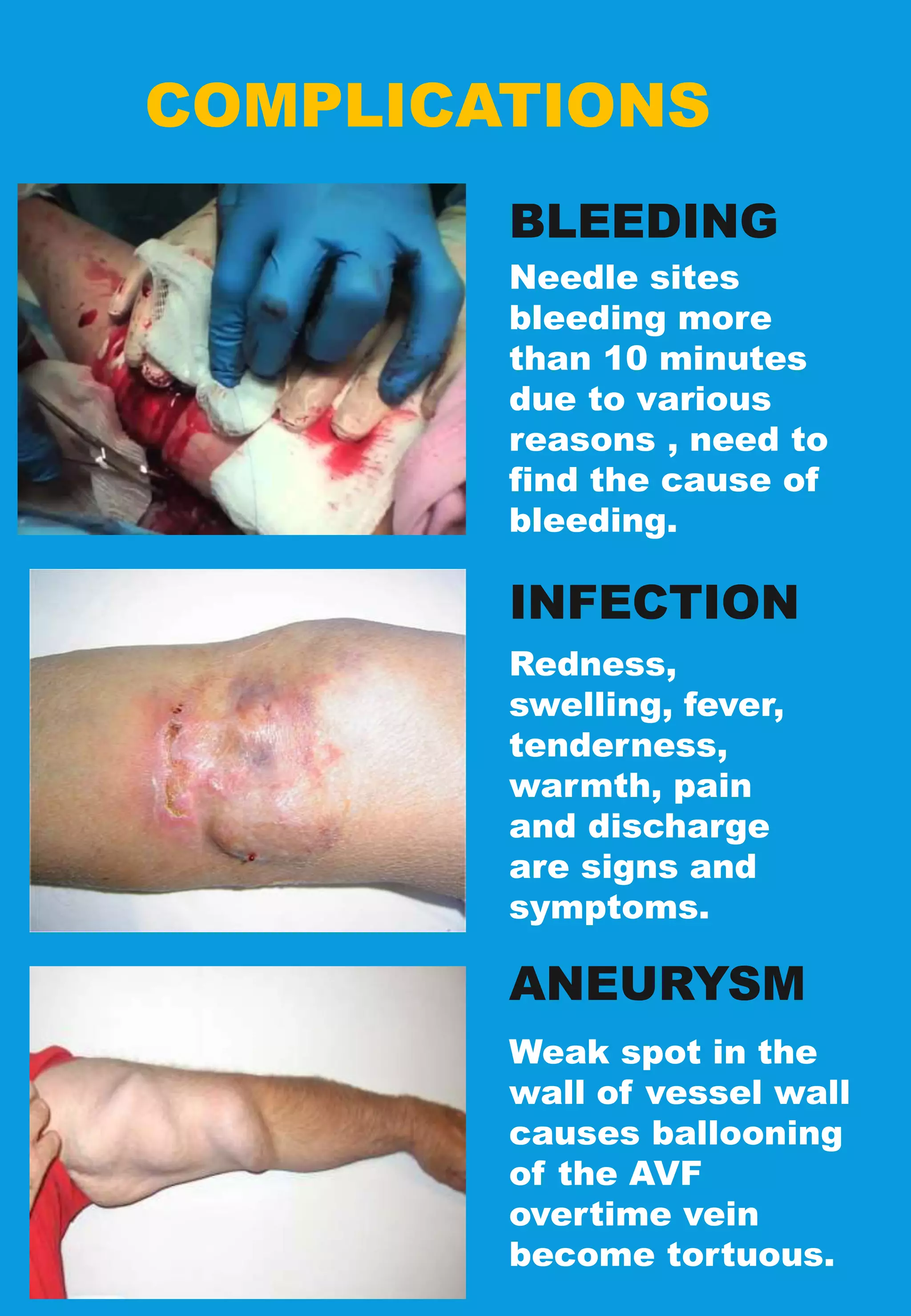 COMPLICATIONS
Needle sites
bleeding more
than 10 minutes
due to various
reasons , need to
find the cause of
bleeding.
BLEEDING
INFECTION
ANEURYSM
Redness,
swelling, fever,
tenderness,
warmth, pain
and discharge
are signs and
symptoms.
Weak spot in the
wall of vessel wall
causes ballooning
of the AVF
overtime vein
become tortuous.