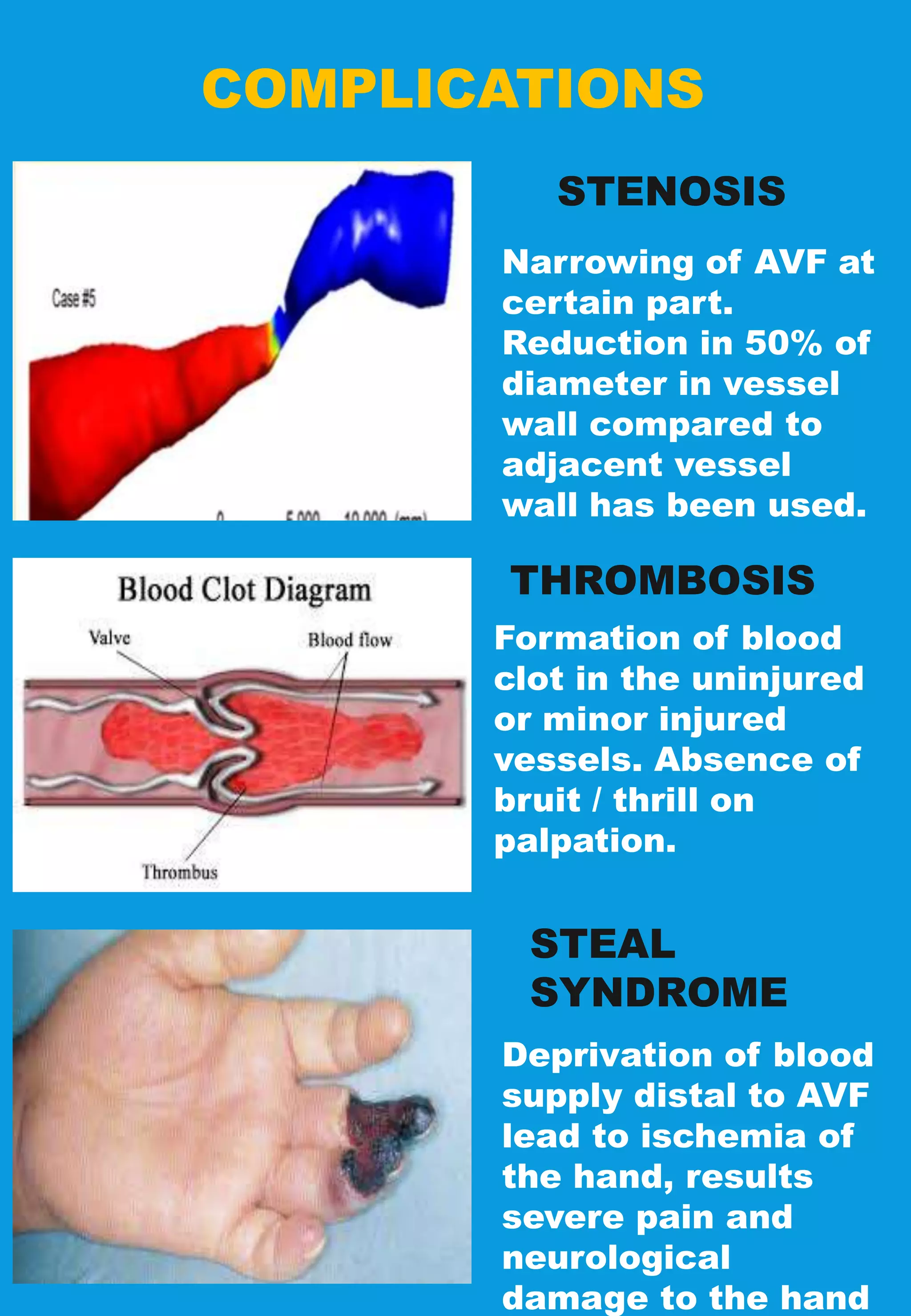 COMPLICATIONS
STENOSIS
Narrowing of AVF at
certain part.
Reduction in 50% of
diameter in vessel
wall compared to
adjacent vessel
wall has been used.
THROMBOSIS
STEAL
SYNDROME
Formation of blood
clot in the uninjured
or minor injured
vessels. Absence of
bruit / thrill on
palpation.
Deprivation of blood
supply distal to AVF
lead to ischemia of
the hand, results
severe pain and
neurological
damage to the hand