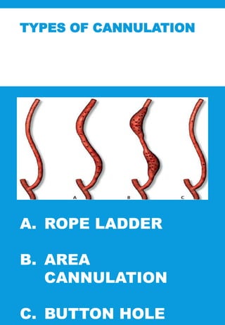 TYPES OF CANNULATION
A. ROPE LADDER
B. AREA
CANNULATION
C. BUTTON HOLE
 