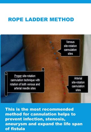 ROPE LADDER METHOD
This is the most recommended
method for cannulation helps to
prevent infection, stenosis,
aneurysm and expand the life span
of fistula
 