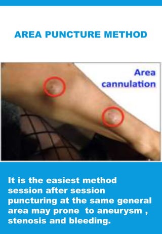 AREA PUNCTURE METHOD
It is the easiest method
session after session
puncturing at the same general
area may prone to aneurysm ,
stenosis and bleeding.
 